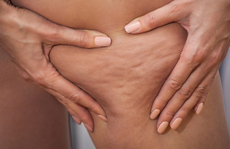 Différents types de cellulite