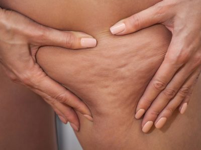 Cellulite : comment reconnaître les trois différents types ?